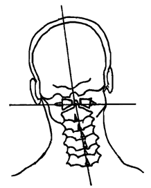 subluxation